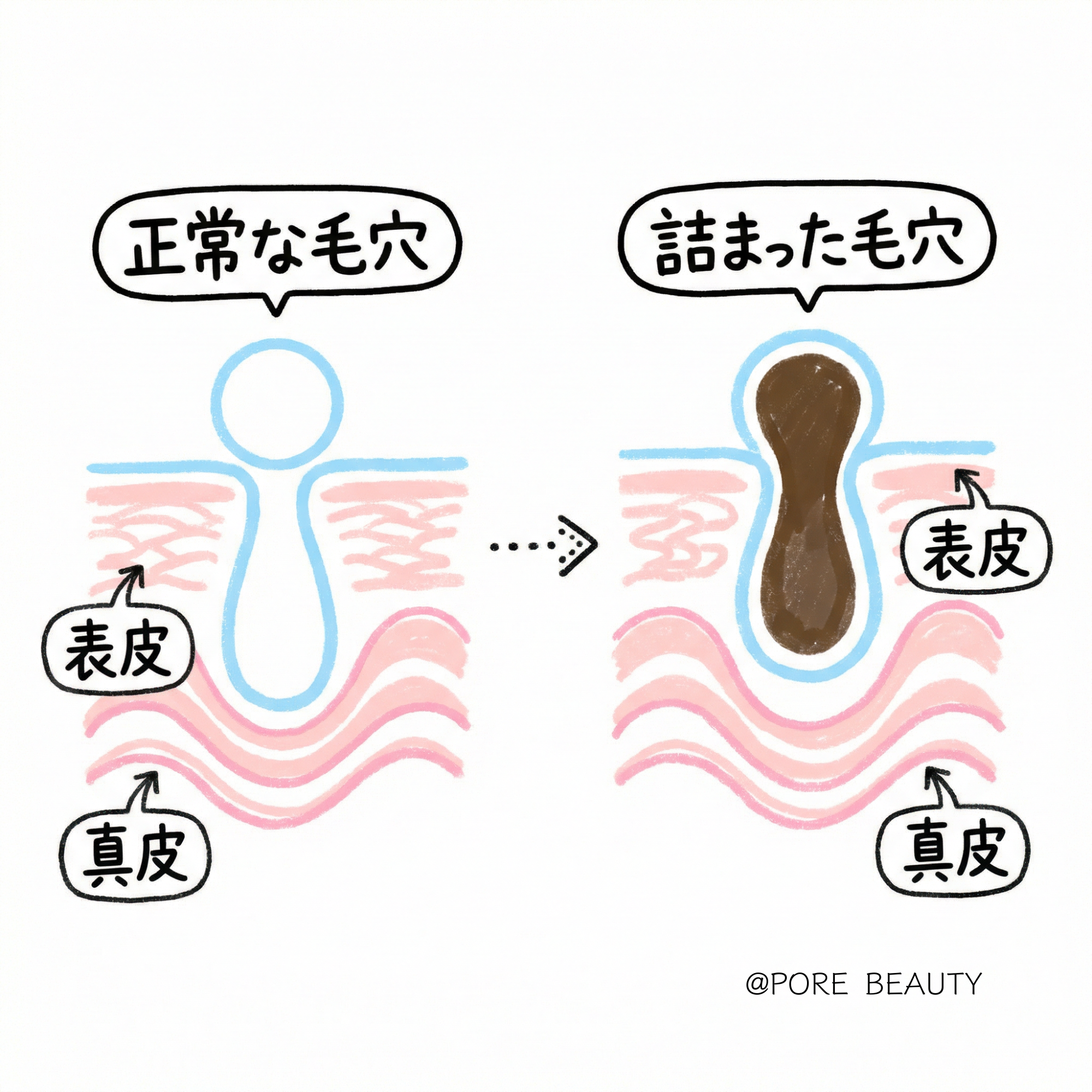 毛穴の構造図解：正常な毛穴と詰まった毛穴の断面イラスト